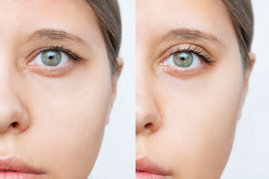 Blefaroplastia sem corte