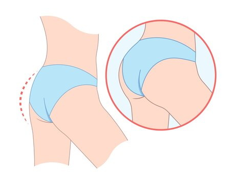 Gluteoplastia preço