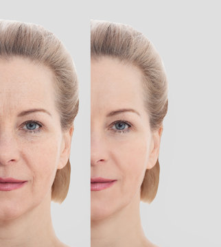 Lifting facial em São Paulo