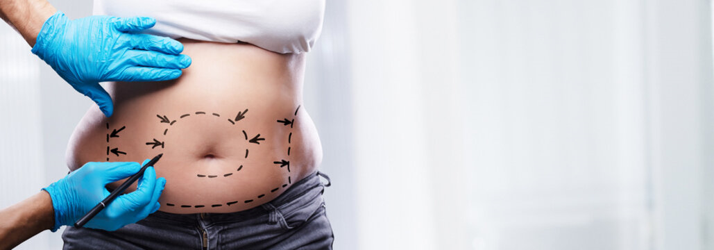 Lipo abdominoplastia em São Paulo