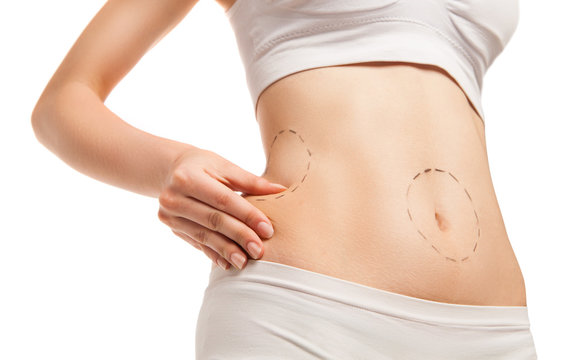 Lipoabdominoplastia